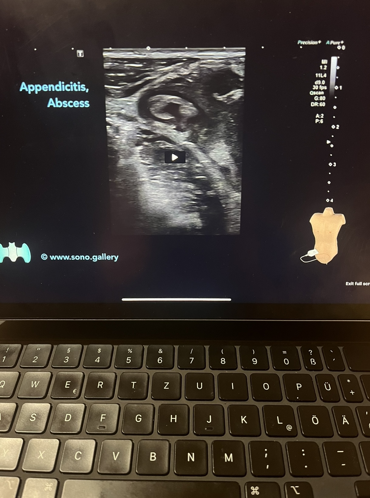 Appendix Sono